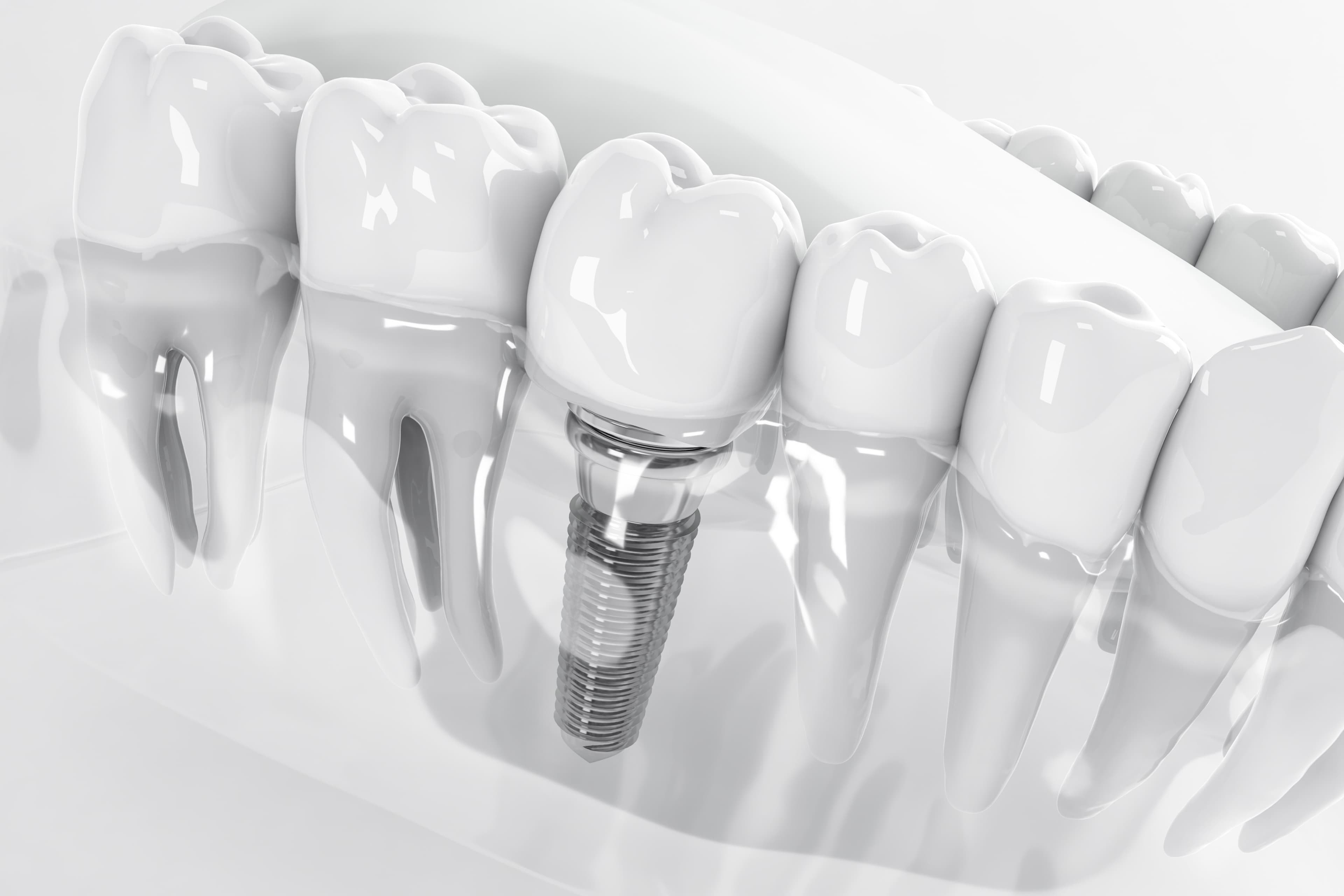Implants image